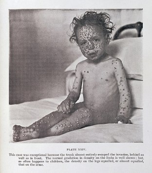 Child_with_Smallpox_Wellcome_L0032953